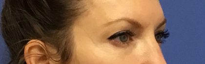 Blepharoplasty Before & After Patient #1843