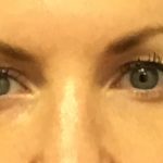 Blepharoplasty Before & After Patient #1843