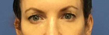 Blepharoplasty Before & After Patient #1843