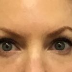 Blepharoplasty Before & After Patient #1843