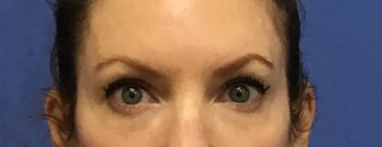 Blepharoplasty Before & After Patient #1843