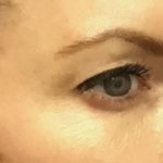 Blepharoplasty Before & After Patient #1843
