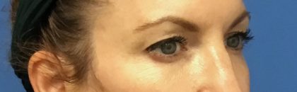 Blepharoplasty Before & After Patient #1843