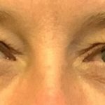 Blepharoplasty Before & After Patient #1848