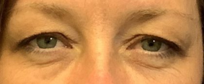 Blepharoplasty Before & After Patient #1848