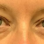 Blepharoplasty Before & After Patient #1848