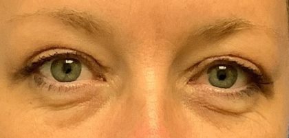 Blepharoplasty Before & After Patient #1848