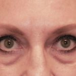 Blepharoplasty Before & After Patient #1851