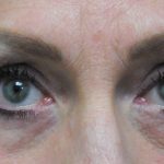 Blepharoplasty Before & After Patient #1851