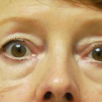 Blepharoplasty Before & After Patient #1854