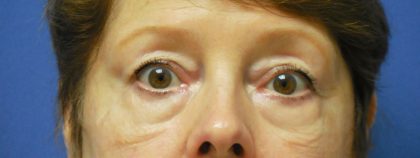 Blepharoplasty Before & After Patient #1854