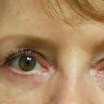 Blepharoplasty Before & After Patient #1854