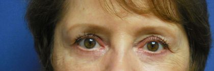 Blepharoplasty Before & After Patient #1854