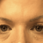 Blepharoplasty Before & After Patient #1857