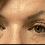 Blepharoplasty Before & After Patient #1857