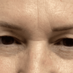 Blepharoplasty Before & After Patient #1860
