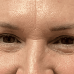 Blepharoplasty Before & After Patient #1860