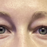 Blepharoplasty Before & After Patient #1863