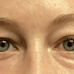 Blepharoplasty Before & After Patient #1863