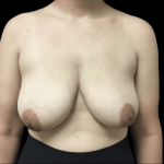 Breast Augmentation Before & After Patient #268