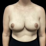 Breast Augmentation Before & After Patient #268