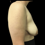 Breast Augmentation Before & After Patient #268