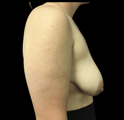 Breast Augmentation Before & After Patient #268