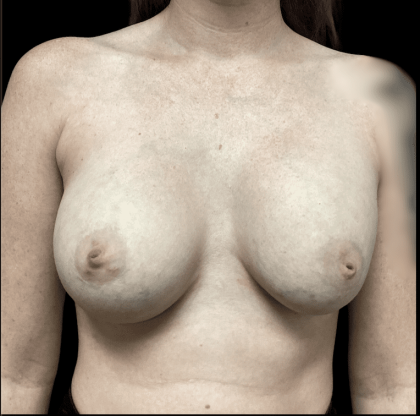 Breast Augmentation Before & After Patient #278