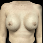 Breast Augmentation Before & After Patient #278