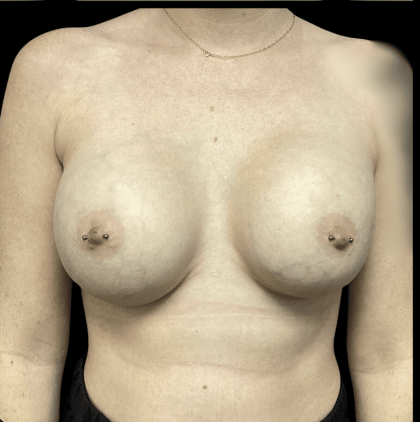 Breast Augmentation Before & After Patient #278