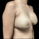 Breast Augmentation Before & After Patient #278