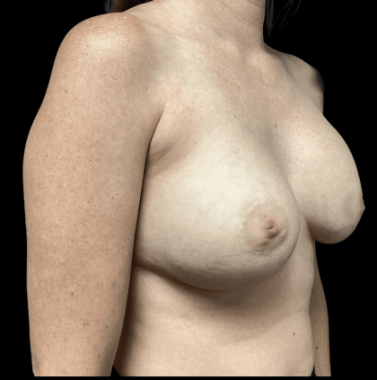 Breast Augmentation Before & After Patient #278