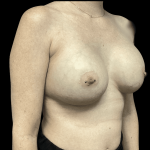 Breast Augmentation Before & After Patient #278