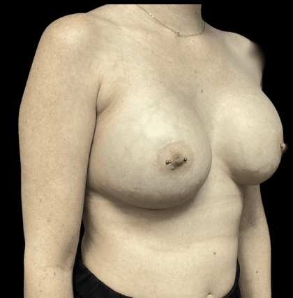 Breast Augmentation Before & After Patient #278