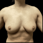 Breast Augmentation Before & After Patient #283