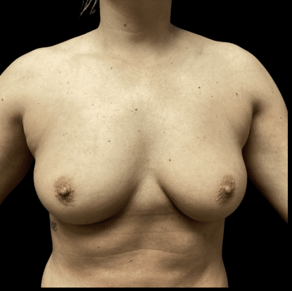 Breast Augmentation Before & After Patient #283