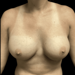 Breast Augmentation Before & After Patient #283