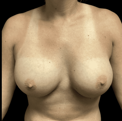 Breast Augmentation Before & After Patient #283
