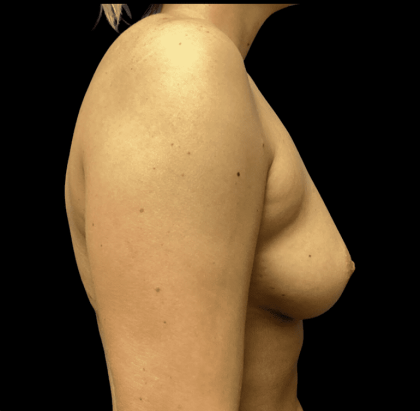 Breast Augmentation Before & After Patient #283