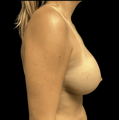 Breast Augmentation Before & After Patient #283