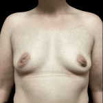 Breast Augmentation Before & After Patient #288