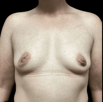 Breast Augmentation Before & After Patient #288