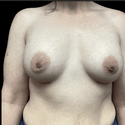 Breast Augmentation Before & After Patient #288