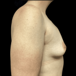 Breast Augmentation Before & After Patient #288