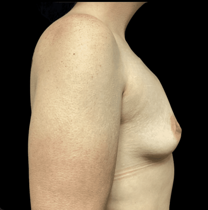 Breast Augmentation Before & After Patient #288