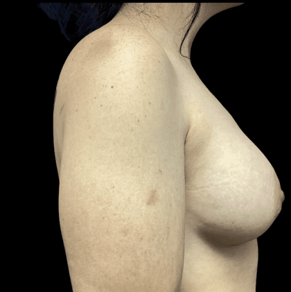 Breast Augmentation Before & After Patient #288