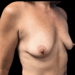 Breast Augmentation Before & After Patient #293