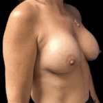 Breast Augmentation Before & After Patient #293