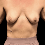 Breast Augmentation Before & After Patient #293