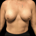 Breast Augmentation Before & After Patient #293
